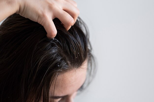 Dandruff vs Dry Scalp: How to Identify and Address Your Scalp Concerns